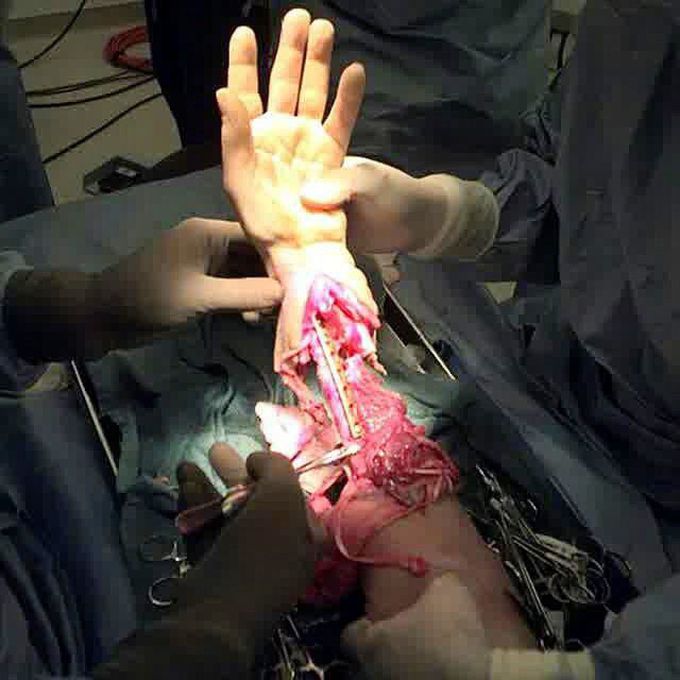Hand transplantation! 👋