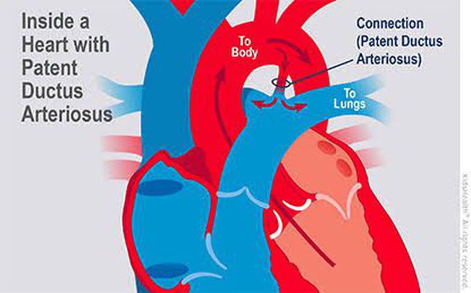 Patent Ductus arteriosus - when does it closes?