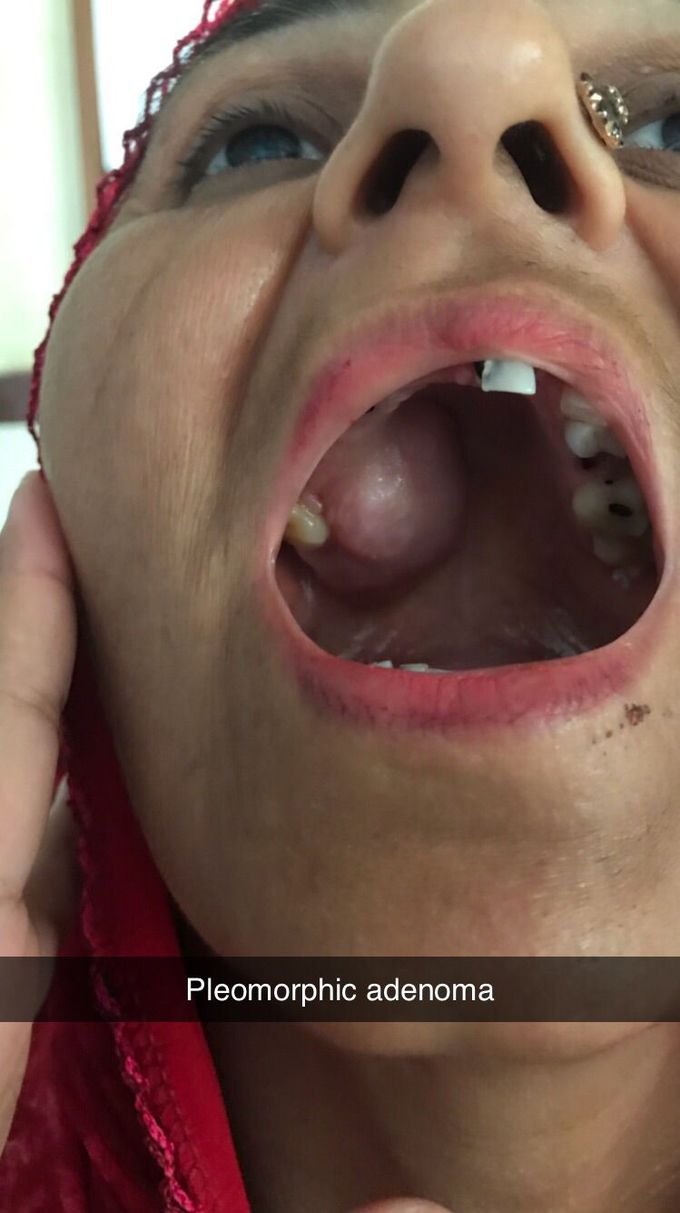 A 35 year old women presented with  swelling on her hard palate with no pain and no difficulty in swallowing or chewing history of tooth plain n dental caries