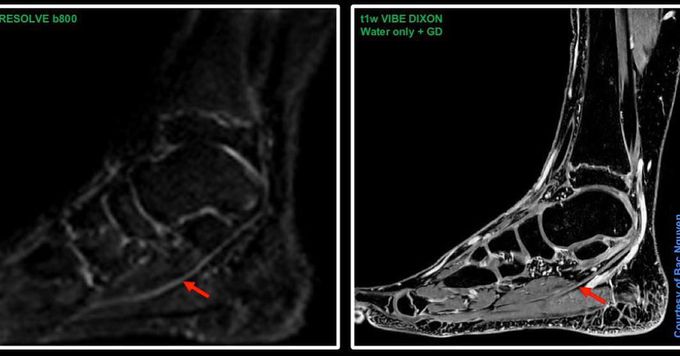 Awesome visualising of the tendon on RESOLVE DWI @ Siemens - MEDizzy