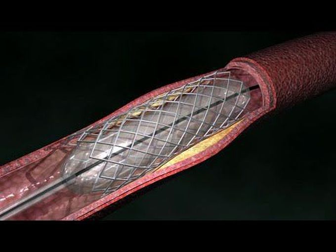 Coronary Artery Angioplasty