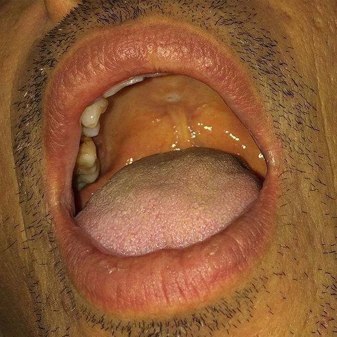 Jaundice on palatum 