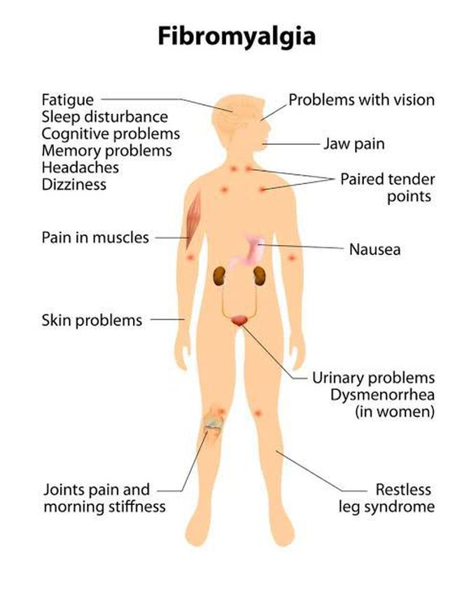 causes of fibromyalgia