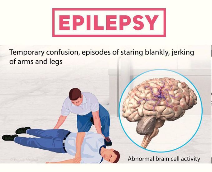 Epilepsy🧠