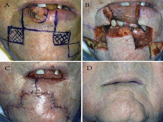 Squamous cell carcinoma of the lower lip reconstructed using "staircase" flap technique.