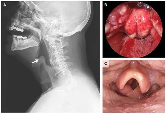 Causes of acute epiglotittis