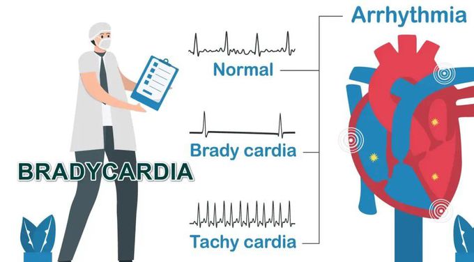 Treatment for Sinus bradycardia