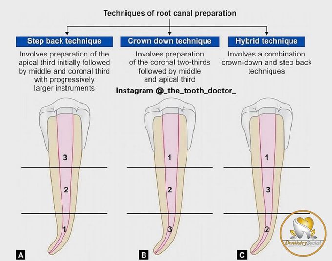 Techniques of Root canal Preparation
