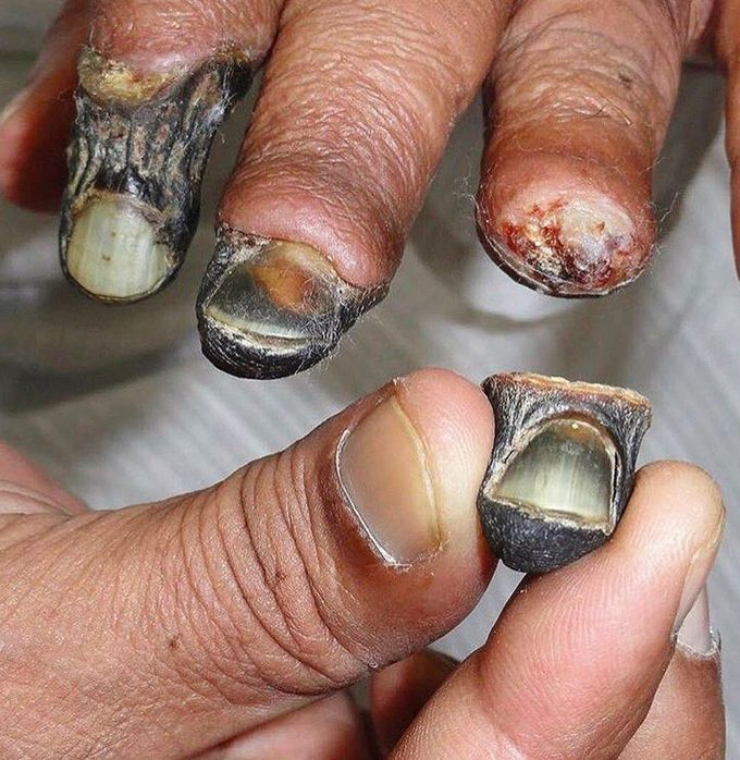 What is your diagnosis ? And which type is it ??