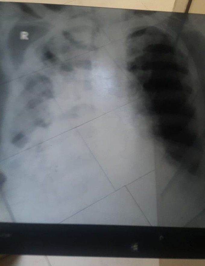 X-ray Chest P.A. View