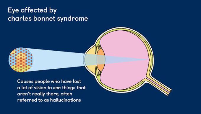 These are the symptoms of Charles bonnet syndrome