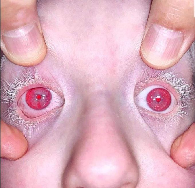 OCULAR ALBINISM