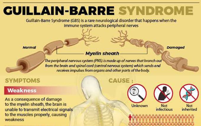 These are the symptoms of Guillain barre syndrome