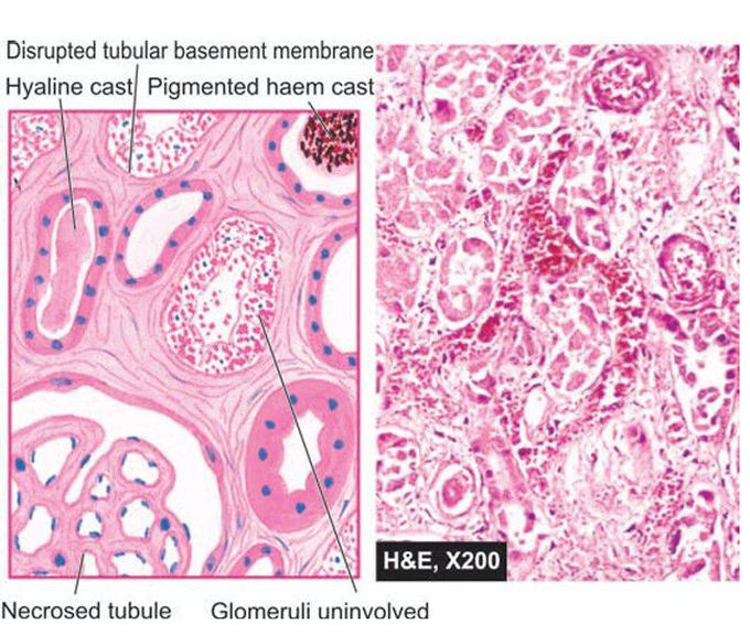 Ischaemic Acute tubular necrosis