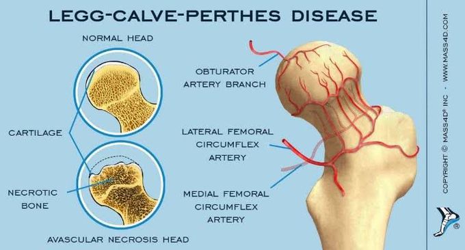 Legg-Calve-Perthes Disease