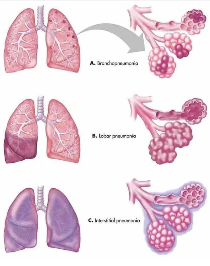 Types of Pneumonia