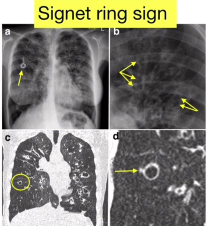 Signet Ring sign