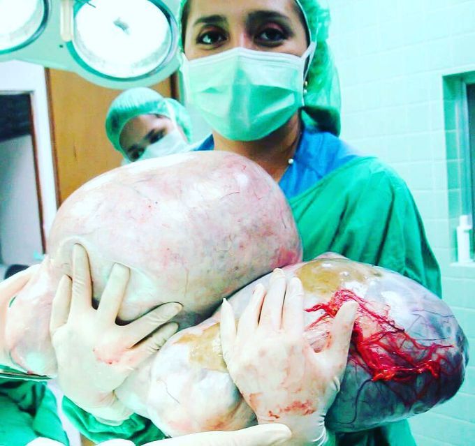 Huge ovarian cyst