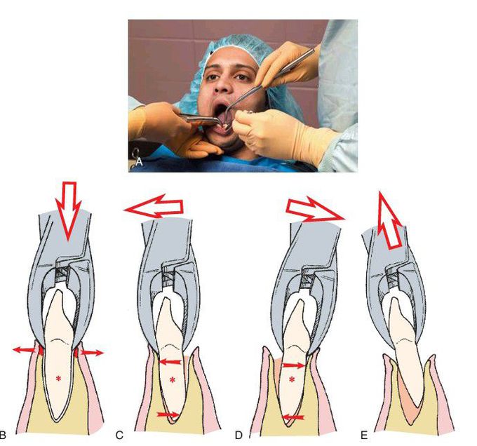 Mandibular anterior teeth extraction