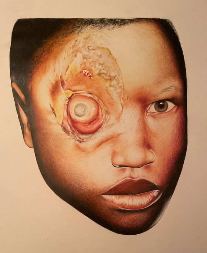 Pencil illustration of a child with Buruli ulcer
