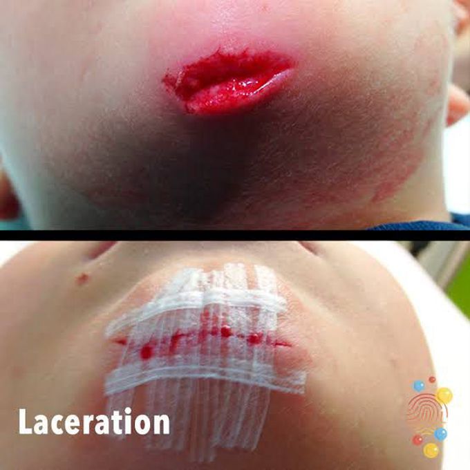 Symptoms of laceration
