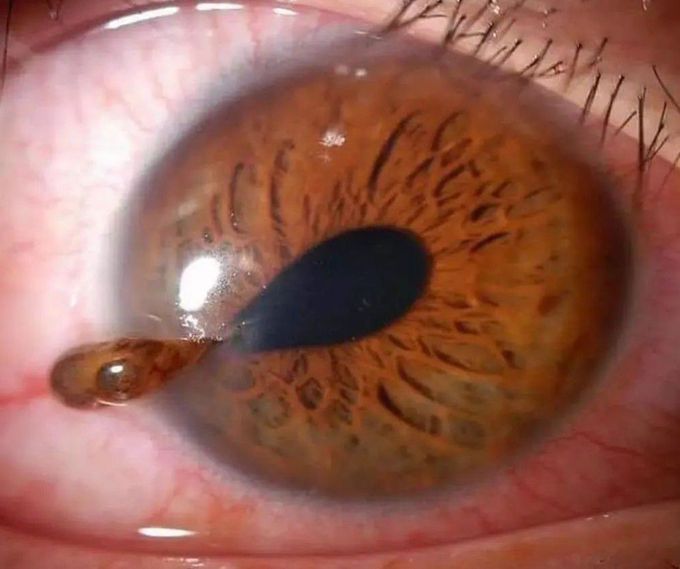 Tear-drop Shaped Pupil