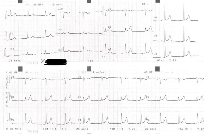 Any idea what’s going on in this ECG?