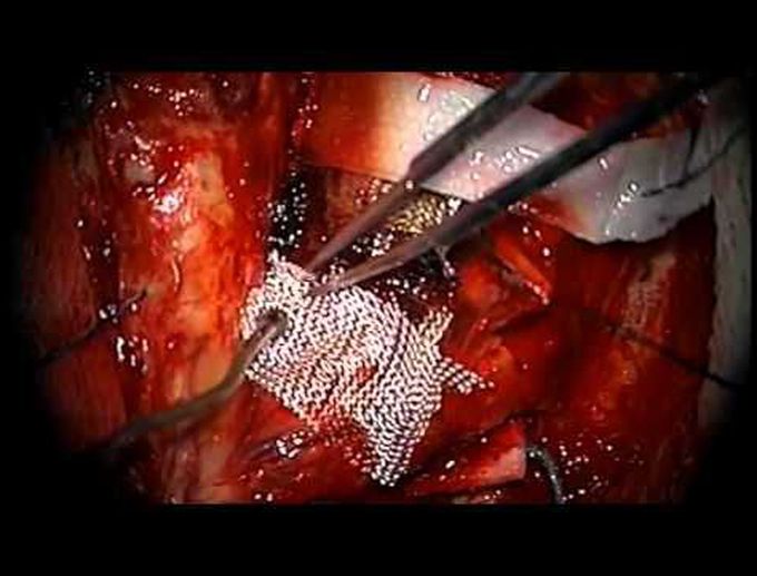 Supracerebellar transtentorial removal of a large tentorial tumor
