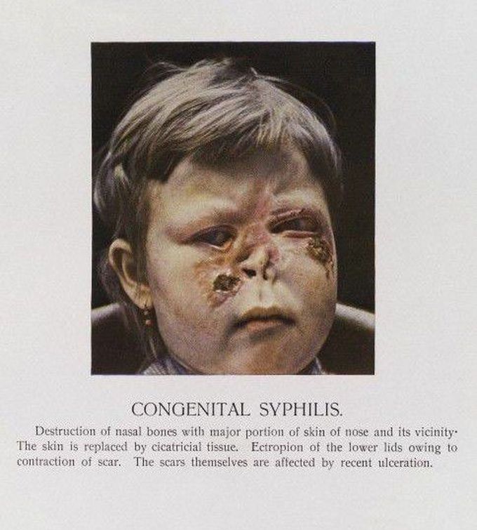 Congenital Syphilis