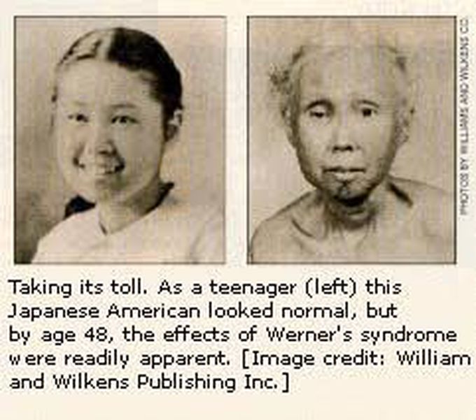 Werner Syndrome