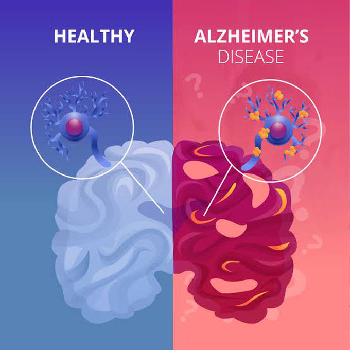 causes of alzheimer's disease