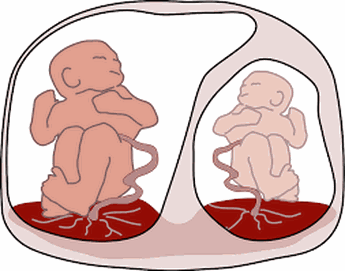 Twin-Twin transfusion syndrome