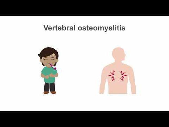 Osteomyelitis - Animation