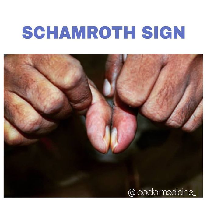 Schamroth sign