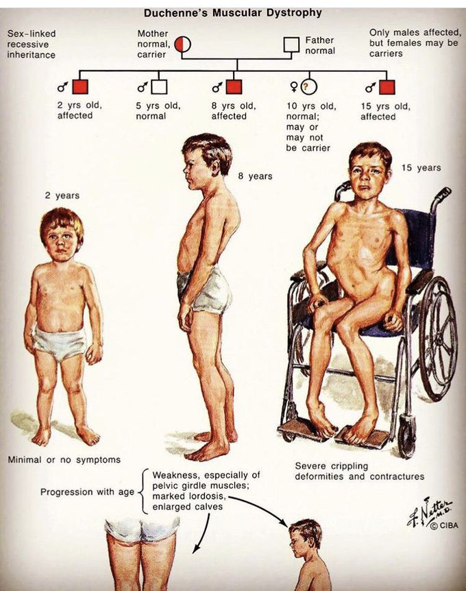 muscular dystrophy