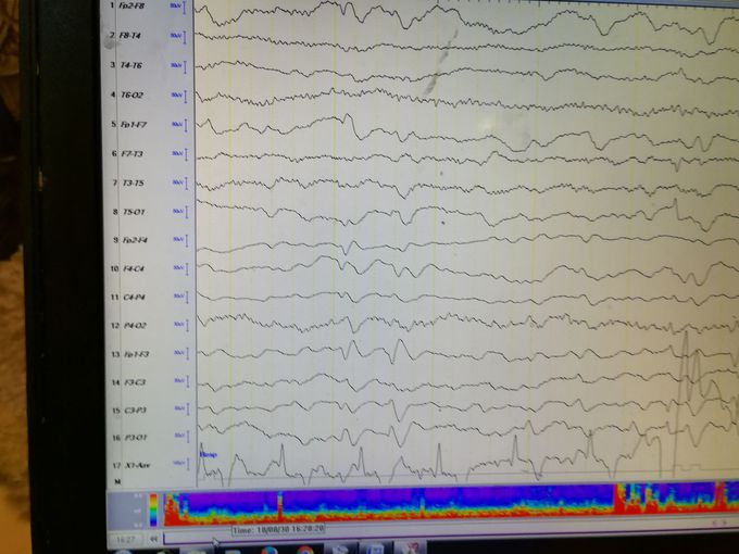 Triphasic waves