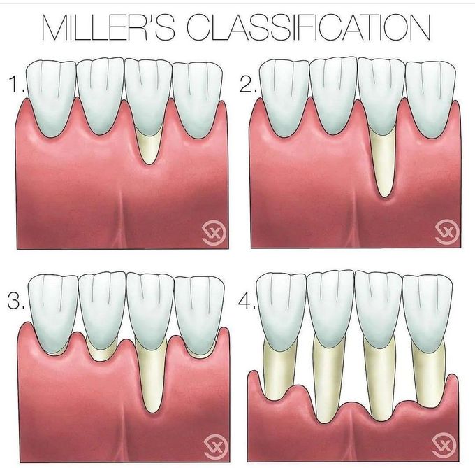 Miller's Classification