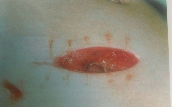 Major wound infection with superficial skin dehiscence
