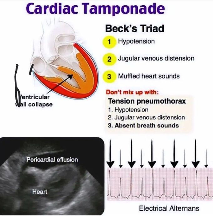 Cardiac Tamponade