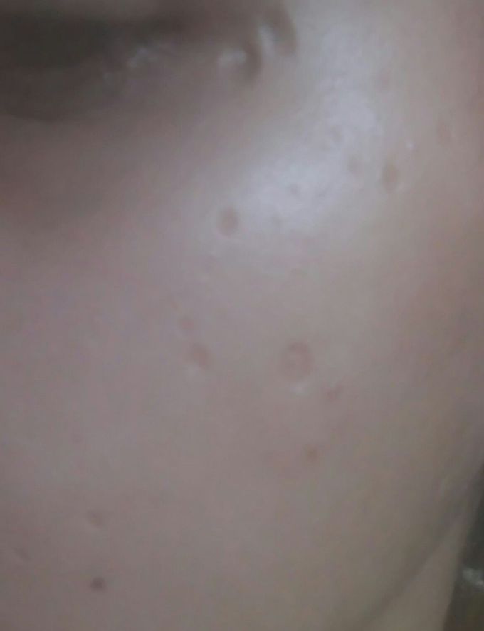 Chicken pox