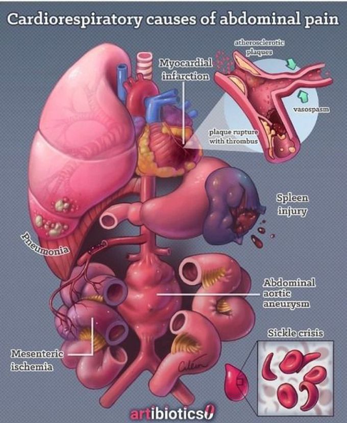 Cardiorespiratory causes_abdominal pain