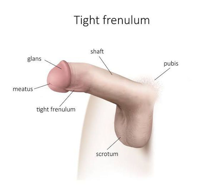 Treatment of frenular chordee