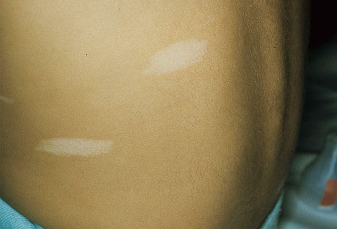Ash Leaf Spots in Tuberous Sclerosis