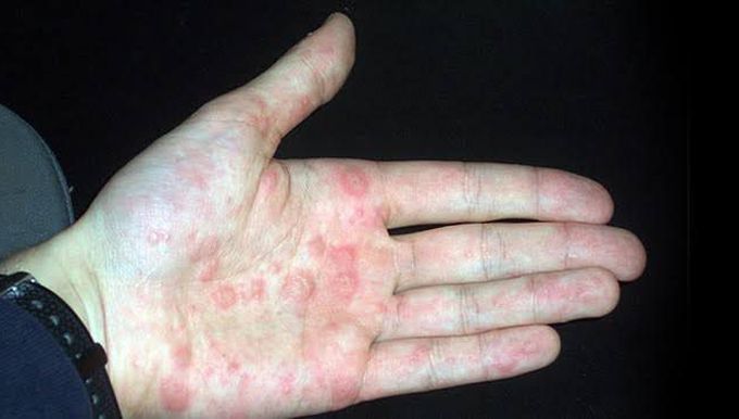 Dyshidrotic eczema