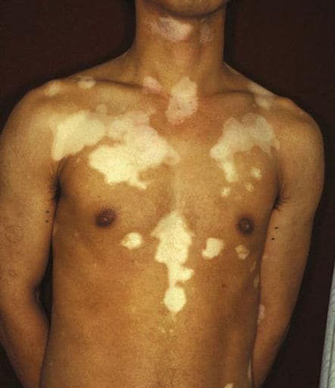 Vitiligo