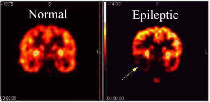 Epileptic