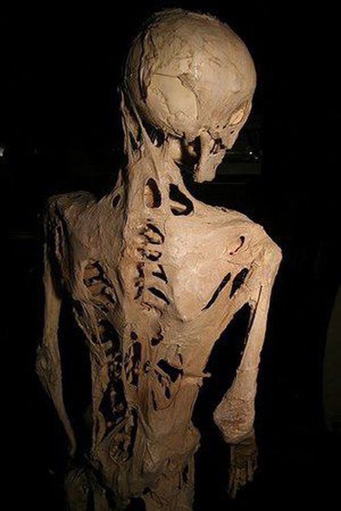 Fibrodysplasia ossificans progressiva (FOP)