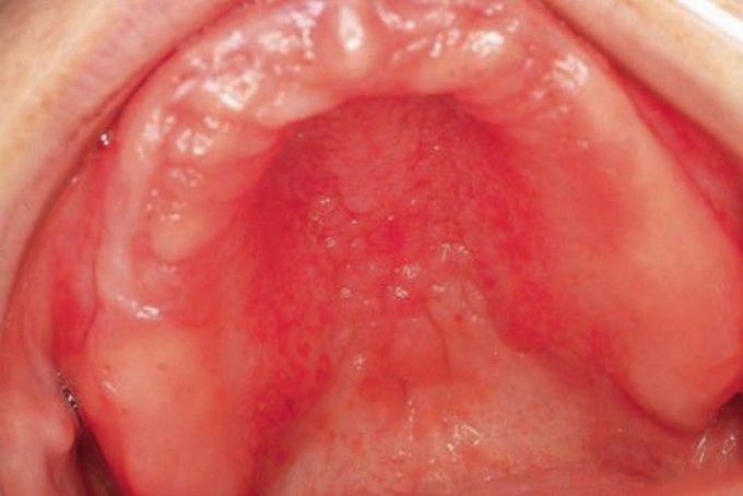 Papillary hyperplasia