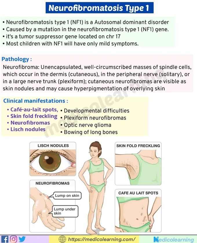 Neurofibromatosis- Quick Review