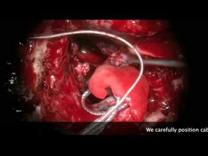 Translabyrinthine resection of neurofibromatosis type 2 associated vestibular and facial schwannomas